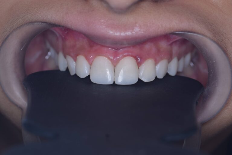 Cosmetic Filling