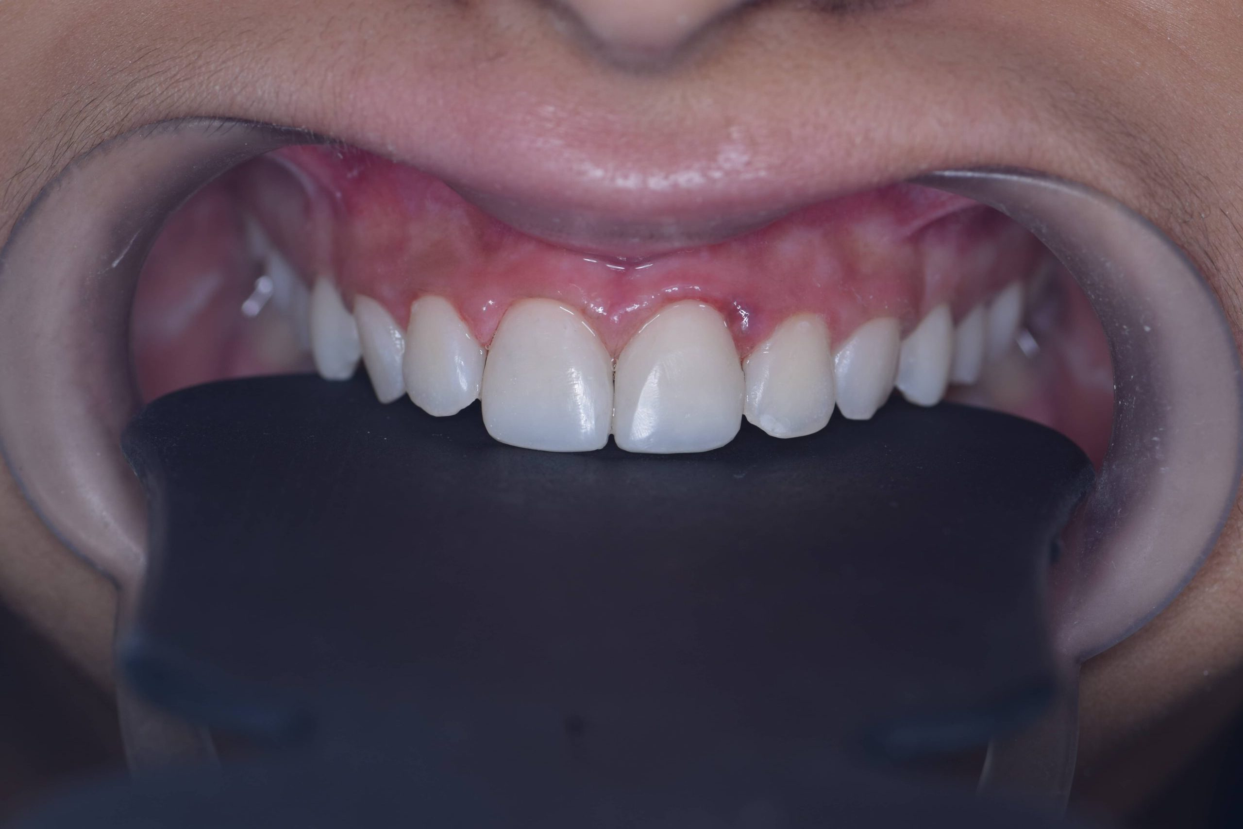 Cosmetic Filling