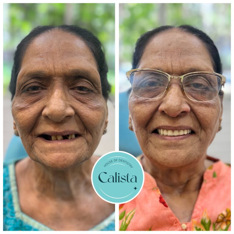 Complete Dentures