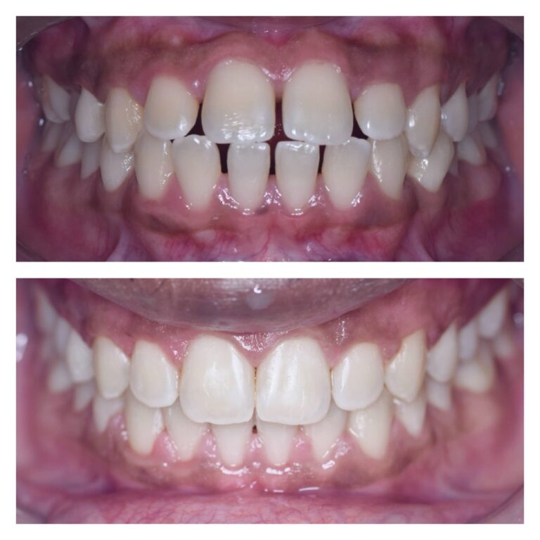 Gaps between teeth