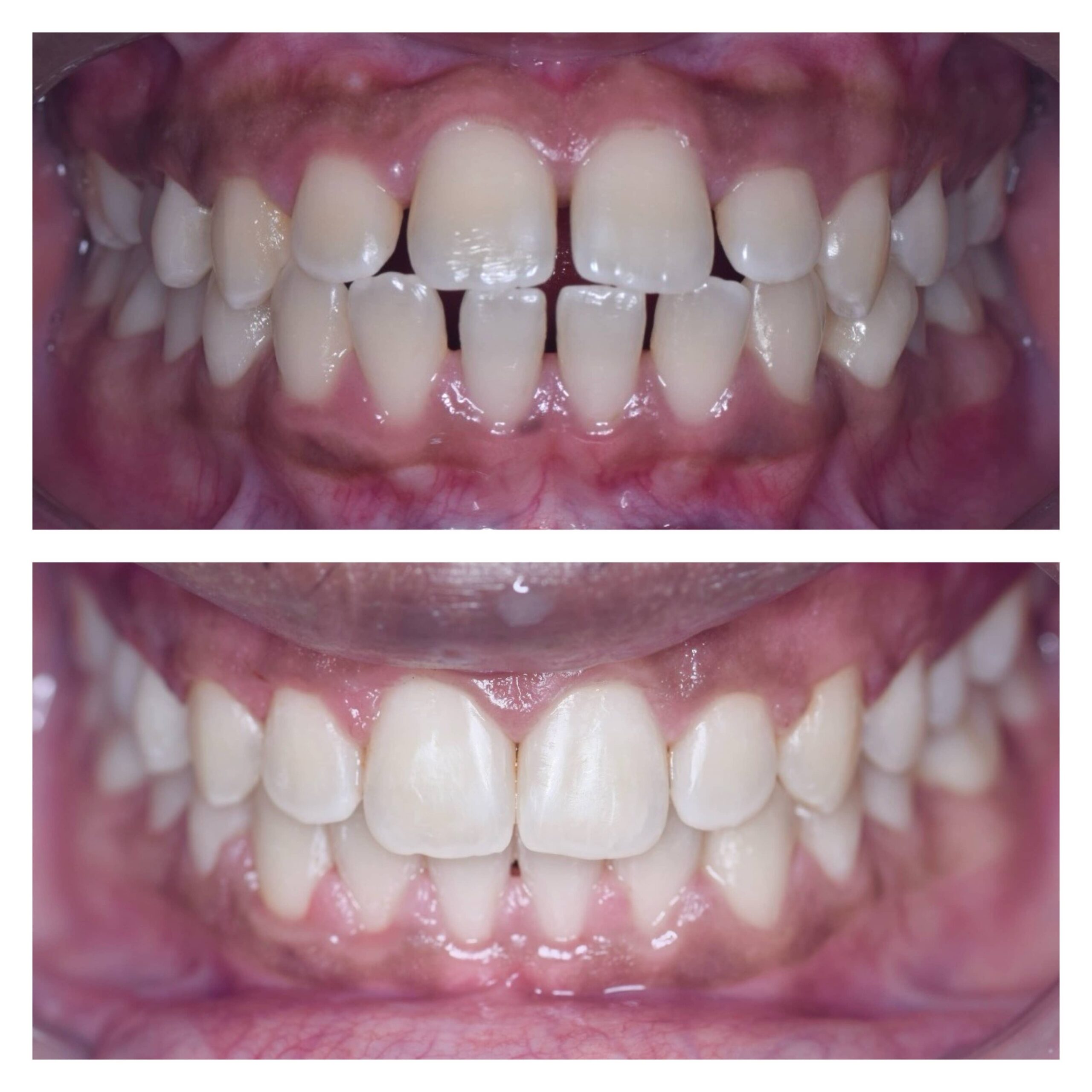 Gaps Between Teeth
