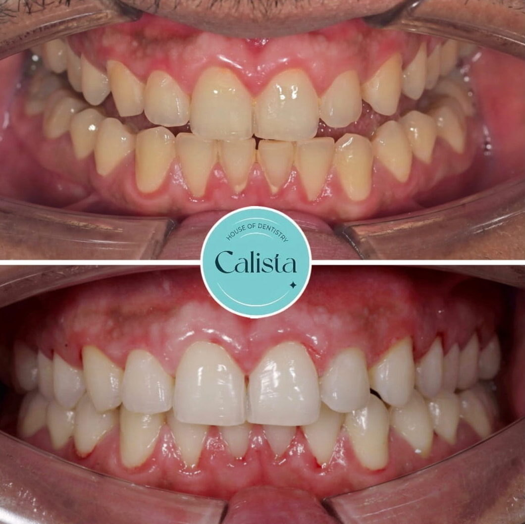 Teeth whitening treatment at Calista Dental, Mumbai