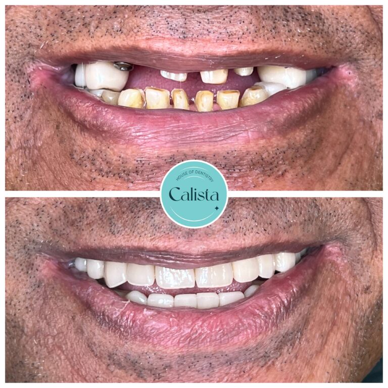 Broken/Missing Teeth