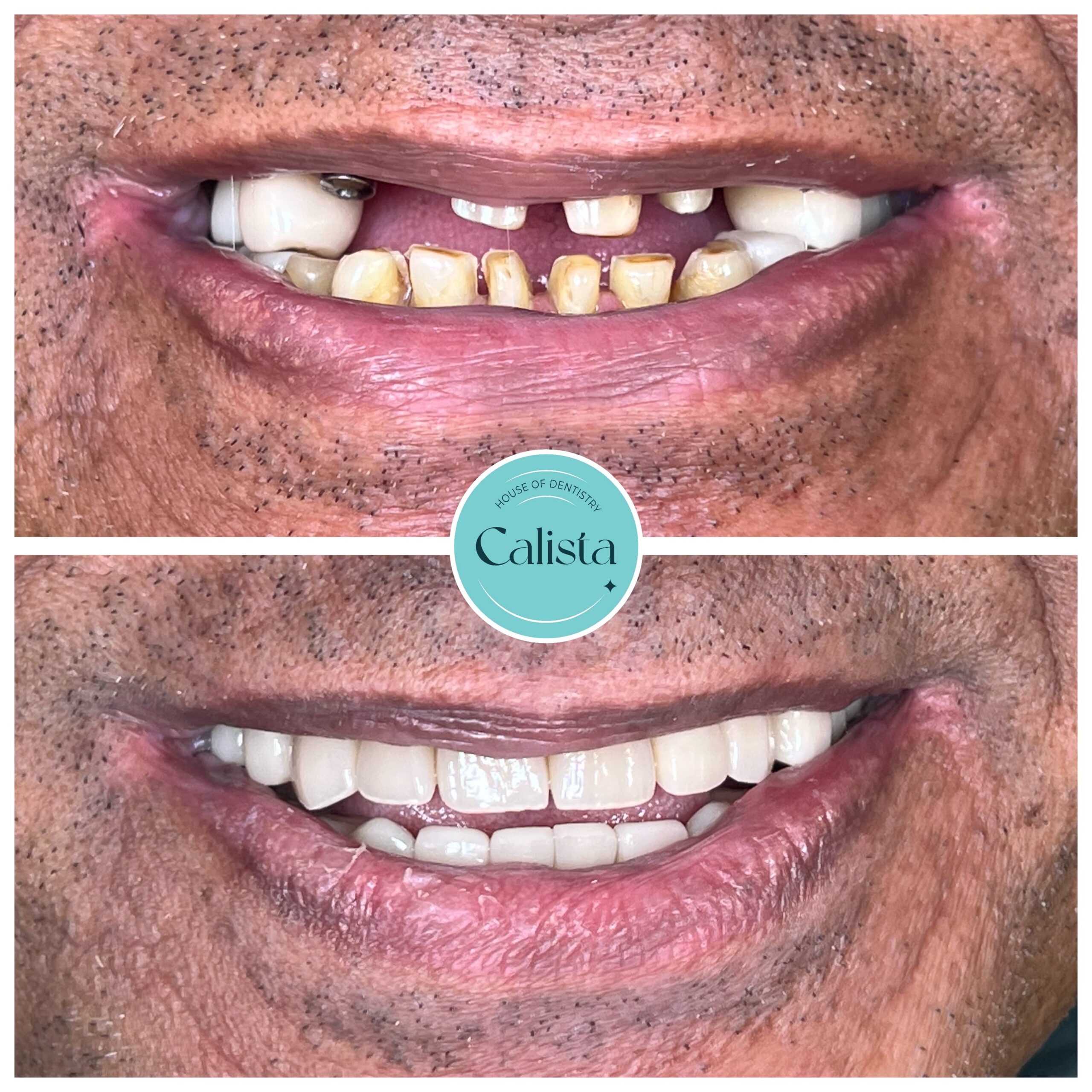 Full Mouth Rehab