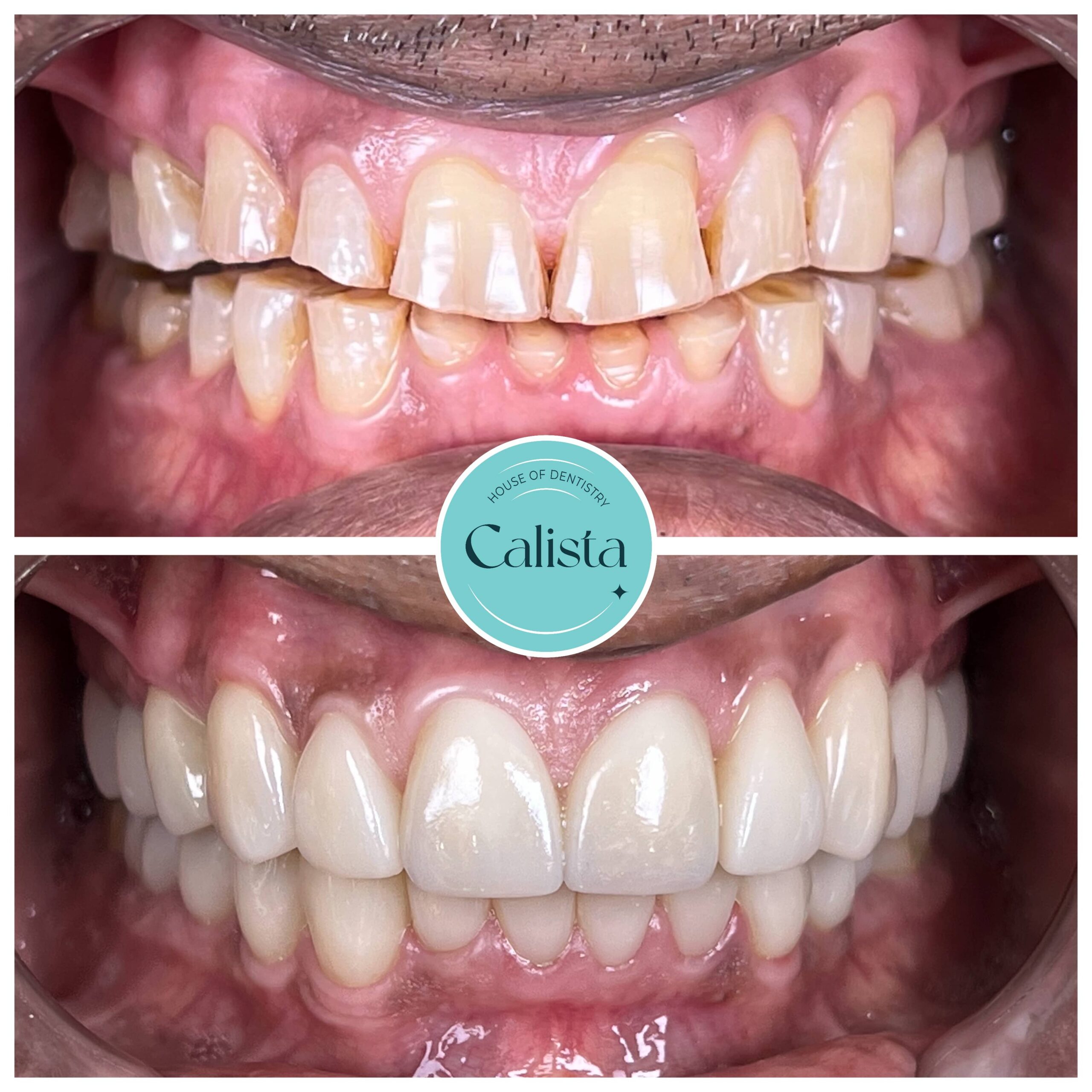 Full Mouth Rehab 2