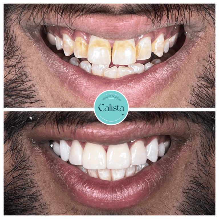 Stained Teeth