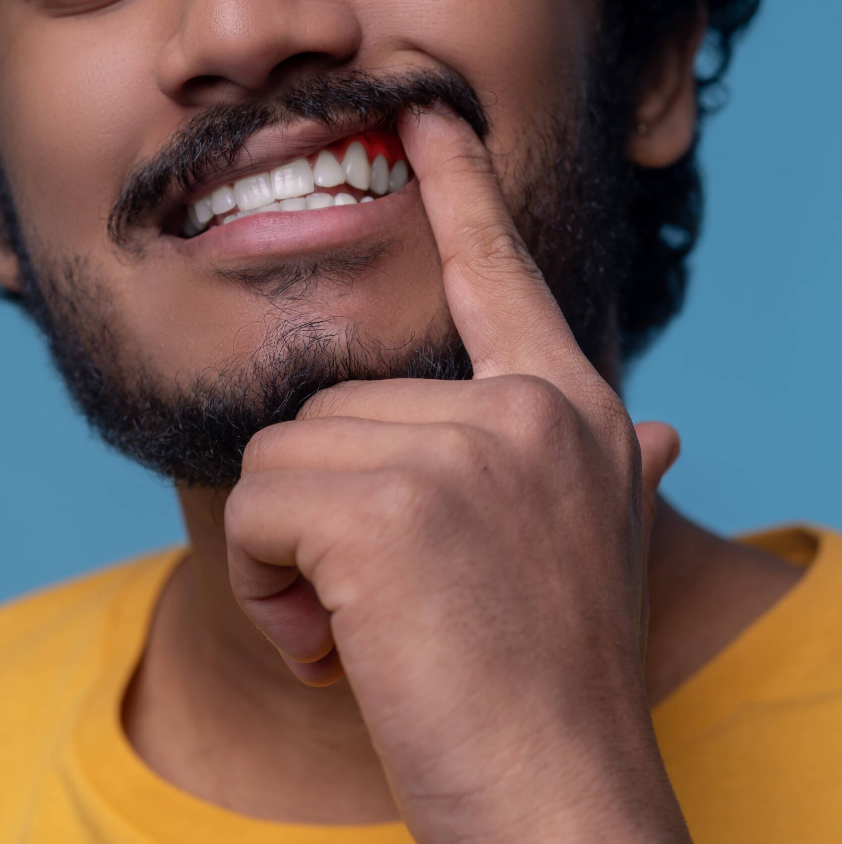 Man with bleeding gums and periodontal disease — Calista Dental