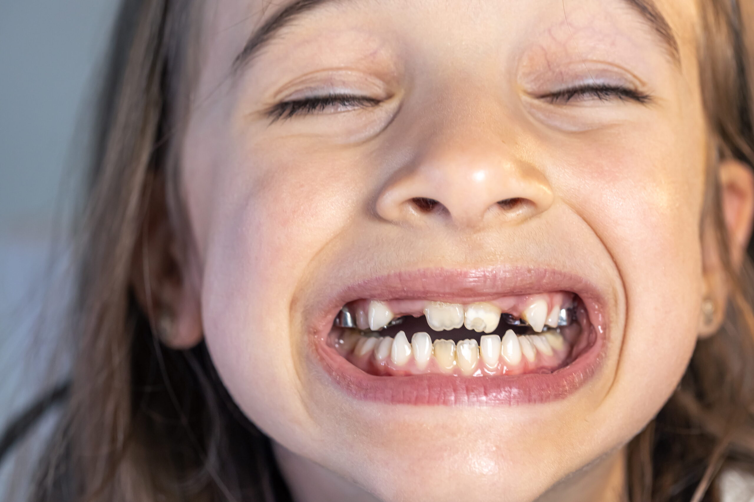 Missing teeth consultation at Calista Dental