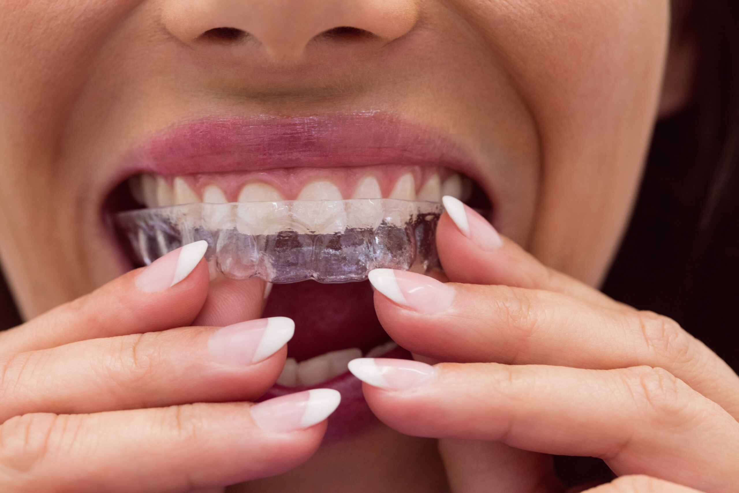 Female patient wearing invisible braces — Calista Dental