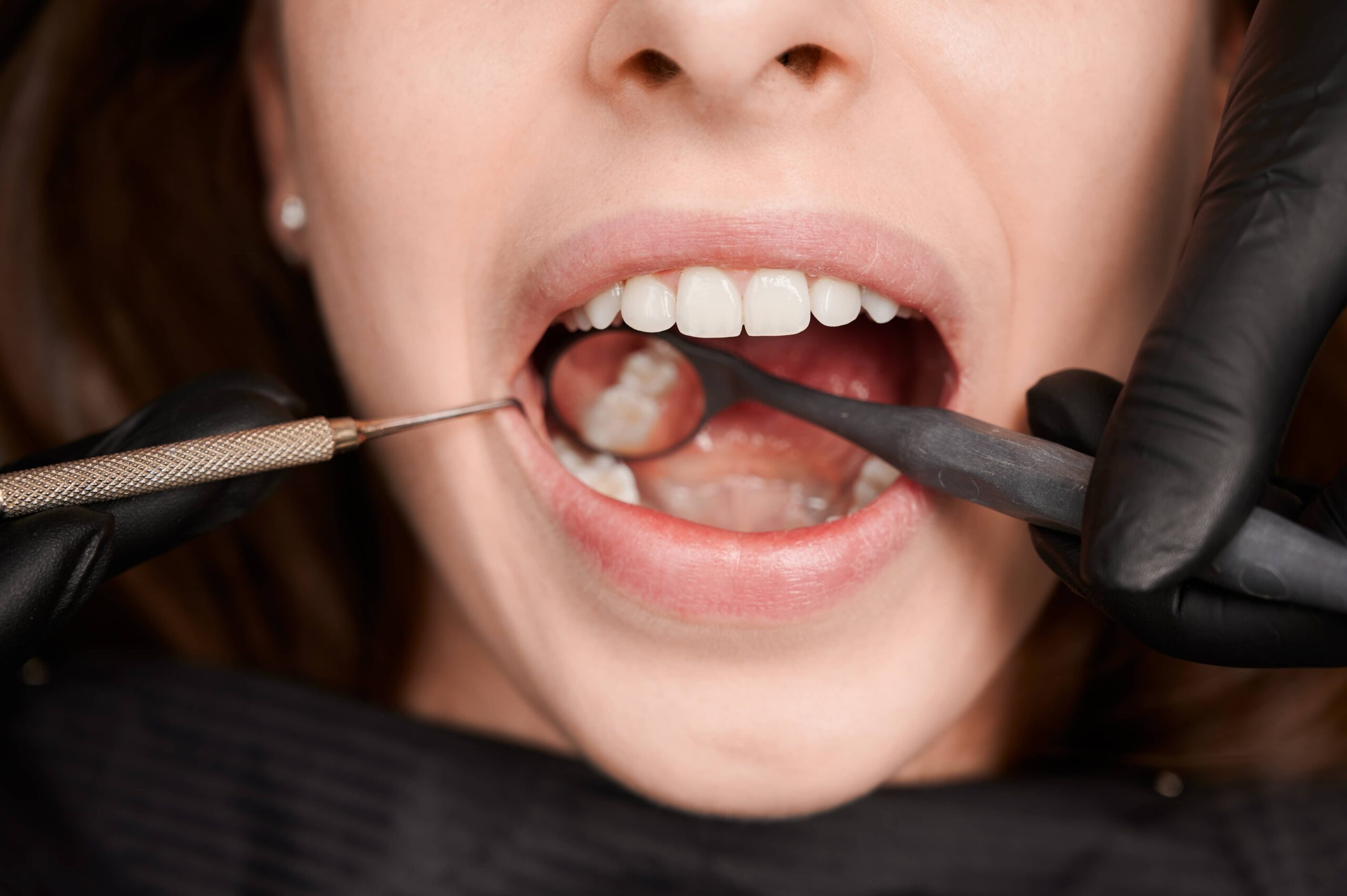 Healthy smile after cavity treatment at Calista Dental